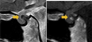 Cortes sagitales en secuencias T2 Y T1 de RM cerebral. A) Se observa la continuidad cortical y medular de la espina ósea con el dorso de la silla turca. B) La espina muestra hiperseñal en secuencia T1 indicando la presencia de médula ósea.