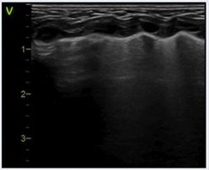 Utilidad De La Ecografía Pulmonar En El Diagnóstico Y Seguimiento De La ...