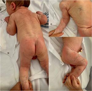 Lesiones vasculares presentes al nacimiento, características de cutis marmorata telangiectásica congénita.