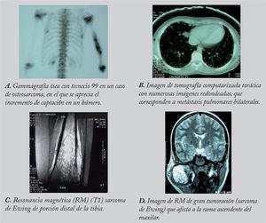 Diversas exploraciones radiológicas en los tumores óseos malignos.