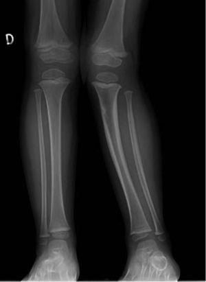 Deformidad en valgo secundaria a fractura incompleta de tibia proximal.