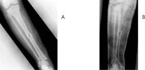 Fractura diafisaria de tibia asociada a epifisiólisis de tibia distal y fractura diafisaria distal de peroné desplazadas (A). Reducción y estabilización con una aguja de Kirschner (B).