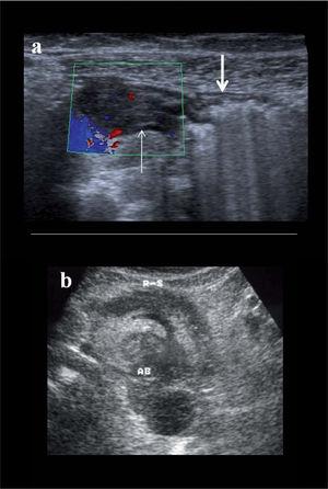 Complicaciones en la enfermedad de Crohn. A) Estenosis por fibrosis (flecha fina) con marcada dilatación preestenótica (flecha gruesa). B) Corte axial a nivel de pelvis que muestra el sigma (R-S) con pared engrosada y una masa abigarrada posterior (AB), con áreas hipoecoicas, que corresponde a un absceso.