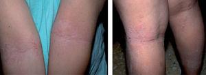 Dermatitis atópica: fase infantil.