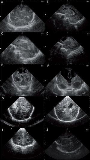 A) Corote sagital: hemorragia subependimaria derecha. B) Corte sagital, imagen anecoica en hendidura ganglio-talámica. Germinólisis evolutiva secundaria a hemorragia subependimaria. C) Corte parasagital, hemorragia subependimaria con componente intraventricular. D) Corte parasagital. HIV II-III. E) Corte coronal, HIV III con ventriculomegalia de ventrículos laterales, tercer y cuarto ventrículos. F) Corte coronal. Hidrocefalia post hemorrágica, medición del index ventricular. G) Corte coronal, infarto periventricular frontoparietal izquierdo. H) Corte coronal, infarto periventricular evolucionado abierto al ventrículo (cavidad porencefálica). I) Corte coronal, leucomalacia periventricular quística a nivel frontal. J) Corte sagital, leucomalacia periventricular parietal y subcortical.