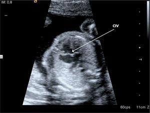 Imagen de un plano ecocardiográfico de un feto de 21 semanas de gestación donde se observa un defecto septal interventricular (CIV).