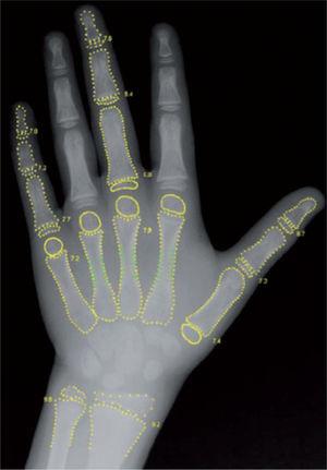 Radiografía de la mano izquierda mostrando los contornos detectados por el método BoneXpert: radio y cúbito distal, metacarpos y falanges. Cada uno de los 15 huesos tiene una edad ósea (EO) asignada y la media resultante es la EO obtenida.