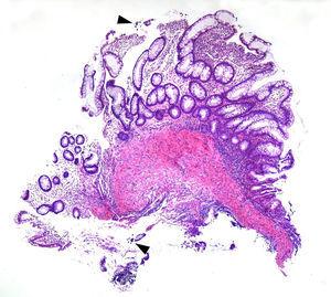 Ileocolitis de Crohn refractaria secundaria a colitis amebiana: un caso ...