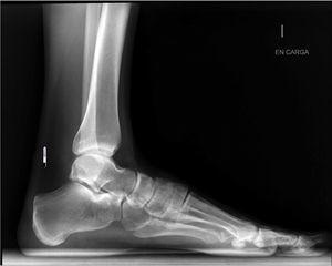 Radiografía lateral de tobillo y pie sin alteraciones.
