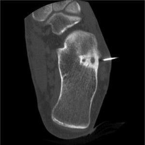 Imagen coronal de TC donde se observa el osteoma osteoide a nivel del calcáneo al realizar la RF.