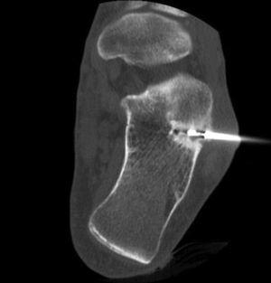 Imagen coronal de TC donde se observa el osteoma osteoide a nivel del calcáneo durante la RF.
