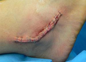 Cierre por planos y piel con grapas. Se observa un menor tamaño de la herida comparado con las plastias no anatómicas.