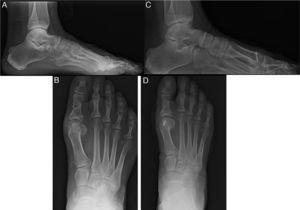 A y B. Hallux rigidus estadio ii perfil y anteroposterior en carga pie derecho. C y D. Osteotomía de Weil un mes postoperatorio. Perfil y anteroposterior en carga pie derecho.