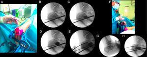 A) Introducción del balón. B-E) Elevación del fragmento subtalar mediante control fluoroscópico. F) Relleno del defecto con el sustituto óseo. G) Imagen prequirúrgica. H) Imagen posquirúrgica.