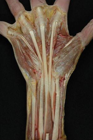 Preparación anatómica en la que se ha resecado el retináculo flexor, mostrando la divergencia de los tendones flexores hacia cada uno de los dedos trifalángicos después de pasar por el túnel carpiano.