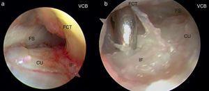 Diagnóstico directo de la lesión foveal del FCT. a) Imagen de inserción foveal sana, visión desde el pdd-RCD. b) Imagen de una desinserción foveal del FCT, visión desde el pdd-RCD. CU: cabeza ulnar; FCT: fibrocartílago triangular; FS: fosa sigmoidea; IF: inserción foveal.