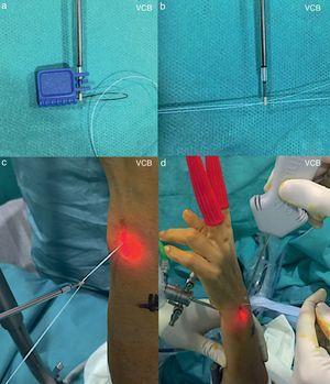 a y b) Paso de los cabos de la sutura a través del orificio del implante. c y d) Introducción del implante por el portal 6R mientras mantenemos la visión desde el pdv-RU.