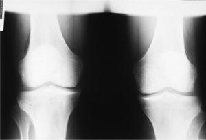 Radiografía anteroposterior de rodillas en la que se aprecia calcificación del cartílago articular.