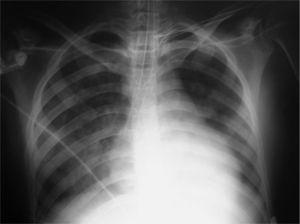 Radiografía de tórax: infiltrado alveolar bilateral.