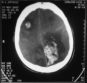 Tomografía computarizada craneal: lesiones isquémicas con transformación hemorrágica en lóbulo frontal derecho y occipital izquierdo con edema y borramiento de surcos y cisuras.
