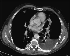 Tomografía computarizada torácica. Se visualiza el neumotorax y el hidroneumotórax, así como pequeños nódulos pulmonares.