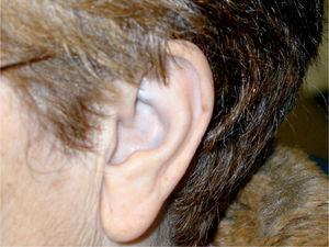 Fotografía del pabellón auricular en la que se evidencia una coloración azulada del cartílago auricular.