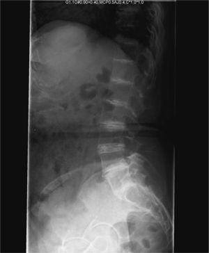 Radiografía de columna lumbar en proyección lateral: se objetiva calcificación de todos los discos intervertebrales y fenómeno del vacío con esclerosis subcondral a nivel de L5-S1.