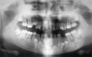 Ortopantomografía: hipoplasia del maxilar inferior. Radiolucidez en hemimandíbula izquierda desde los premolares al segundo molar izquierdo, y en la región del segundo molar derecho con zonas radioopacas e inclusiones mútiples.
