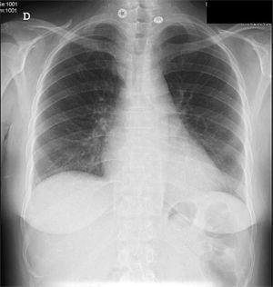 Radiografía en proyección posteroanterior de tórax: ha desaparecido la cardiomegalia y el derrame pleural.
