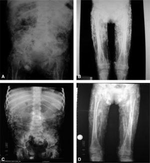 A y B: calcinosis generalizada observada en radiografías simples de abdomen, pelvis y extremidades inferiores al diagnóstico. C y D: la misma paciente, con calcinosis generalizada en regresión después del tratamiento con metilprednisolona intravenosa.