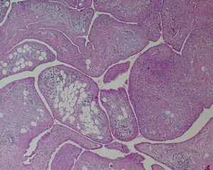 Fotomicrografía. El estudio histológico muestra hiperplasia del tejido adiposo hasta contactar con el revestimiento sinoviocitario. Células grasas maduras y proyecciones vellosas proliferativas reemplazan al tejido sinovial. Las vellosidades están cubiertas por una capa de células adiposas y vasos capilares dilatados y acompañados por una infiltración moderada de linfocitos y células plasmáticas.