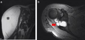 Secuencia T1 (a): tumoración de naturaleza grasa (asterisco). Secuencia axial T2 (b): quiste paralabral en la escotadura espinoglenoidea (flecha).