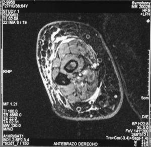 Magnetic resonance of the right arm showing a thickened dermis, an increased of myofascial and interseptal signals and “paved” appearance of the cellular subcutaneous tissue.
