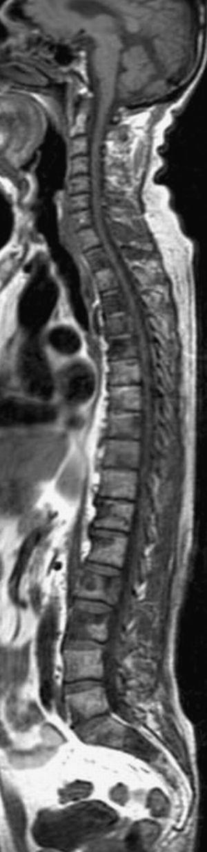 Resonancia magnética (RM) de la columna completa. Estudio completo de RM en corte sagital potenciado en T1 mostrando las múltiples metástasis de los cuerpos vertebrales dorsales, lumbares y sacro de señal hipointensa. La técnica es complementaria en el estudio de RM de cuerpo entero.