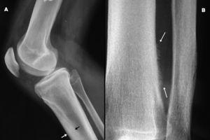 A) Proyección radiográfica lateral de la rodilla derecha en la que puede apreciarse la hiperostosis cortical en la tibia y peroné (flechas). B) Detalle de la periostosis espiculada en la tibia derecha (flechas).