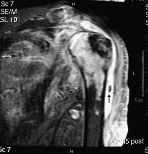 Corte coronal de resonancia magnética del hombro izquierdo, ponderado en T2. Se observa un abundante derrame articular, cuerpos libres (flecha) e irregularidad de la cabeza humeral. Tanto esta como los tejidos periarticulares captan intensamente el contraste de Gadolinio.