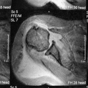 Corte axial de resonancia magnética del hombro izquierdo en el que se visualiza irregularidad de la cabeza humeral y un abundante derrame que distiende todos los recesos de la articulación escapulohumeral.