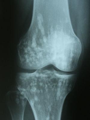 Radiografía simple de rodilla. Lesiones radiodensas ovaladas y confluentes en la epífisis distal del fémur y en la epífisis proximal de la tibia.