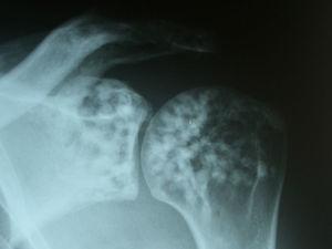 Radiografía simple de hombro. Lesiones radiodensas en la escápula y en la epífisis proximal del húmero. De forma característica, estas lesiones suelen agruparse en las zonas periarticulares.