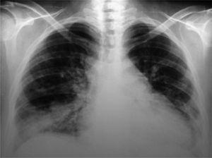 Radiografía de tórax: aumento de la silueta cardíaca, ensanchamiento mediastinal vascular, desaparición de los ángulos costofrénicos y radioopacidades reticulonodulillares perihiliares bilaterales y bibasales, con predominio derecho.