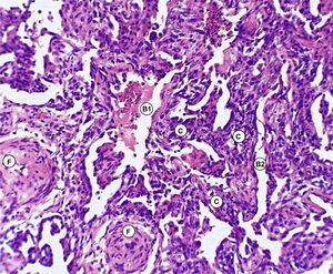 Biopsia de pulmón: coloración hematoxilina-eosina. B1) Espacios alveolares enfisematosos. B2) Alvéolos colapsados. C) Tabiques fibrosos interalveolares. F) Arteriolosclerosis.