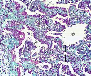 Biopsia de pulmón: coloración tricrómica Masson. B1) Espacios alveolares enfisematosos. B2) Alvéolos colapsados. C) Tabiques fibrosos interalveolares. G) Metaplasia del espacio alveolar.