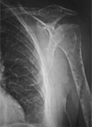 Detalle de radiografía simple de parrilla costal que muestra múltiples lesiones osteoláticas sin actividad osteoblástica visibles en húmero, clavícula y varias costillas.