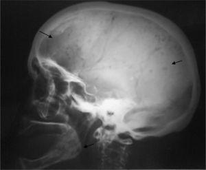 Radiografía simple lateral de cráneo que muestra las lesiones en sacabocados características de mieloma múltiple.