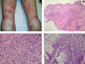A) Lesiones eritematoedematosas localizadas en las piernas. B) Visión panorámica de una lesión, con necrosis central e infiltrados mononucleares periféricos (H-E, ×40). C) Detalle de los infiltrados granulomatosos de células epiteliodes en las paredes vasculares con discreto daño endotelial (H-E, ×500). D) Detalle de la necrosis focal en alguna glándula sebácea (H-E, ×500).