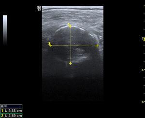 Corte transversal: dilatación aneurismática arteria poplítea con trombo en su interior.