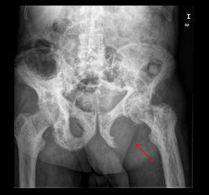 Múltiples lesiones compatibles con enfermedad de Paget y una imagen lítica de mayor tamaño en isquion izquierdo.