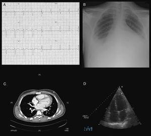 Estudios de apoyo paraclínico que evidenciaron la presencia de miopericarditis: taquicardia sinusal y ondas T negativas en derivaciones V4-V6 del ECG (A), cardiomegalia global y derrame pleural bilateral en la radiografía de tórax (B), derrame pleuropericárdico y cardiomegalia en la TC toraco-abdominal (C), derrame pericárdico leve a moderado en el ecocardiograma (D).