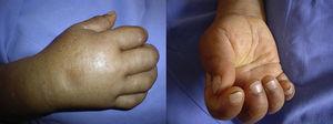 Edema de manos con fóvea, sinovitis e incapacidad para cerrar el puño.