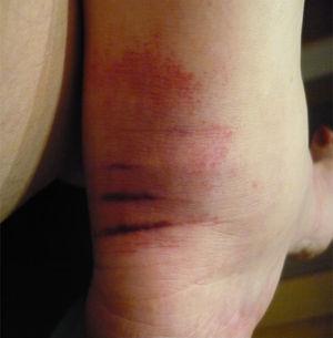Artritis del tobillo con lesiones cutáneas en una paciente con granulomatosis con poliangeítis (Wegener).